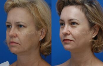 Brow Lift Before and After | Sayah Institute