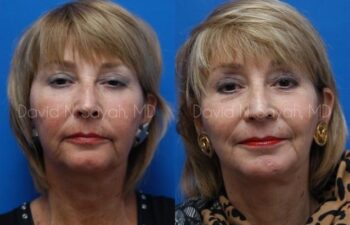 Chin Implant Before and After | Sayah Institute