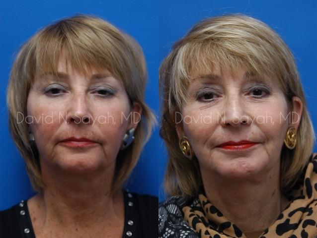 Chin Implant Before and After | Sayah Institute