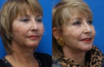 Chin Implant Before and After | Sayah Institute