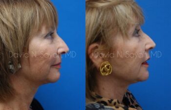 Chin Implant Before and After | Sayah Institute