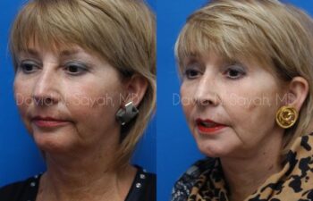 Chin Implant Before and After | Sayah Institute