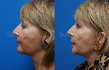 Chin Implant Before and After | Sayah Institute