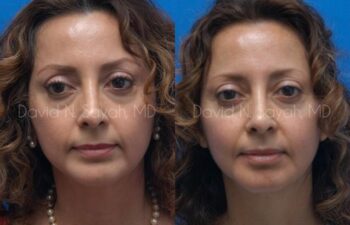 Chin Implant Before and After | Sayah Institute