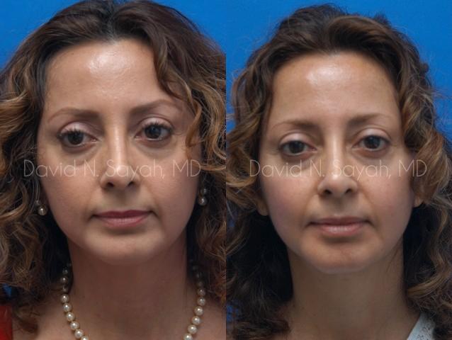 Chin Implant Before and After | Sayah Institute