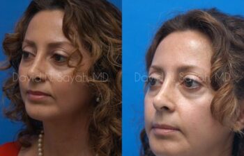 Chin Implant Before and After | Sayah Institute