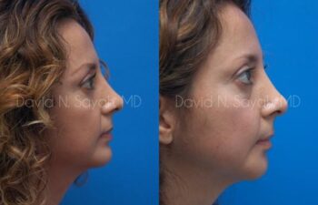 Chin Implant Before and After | Sayah Institute