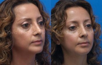 Chin Implant Before and After | Sayah Institute