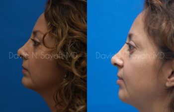 Chin Implant Before and After | Sayah Institute