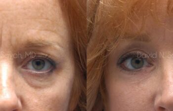 Eyelid Surgery Before and After | Sayah Institute