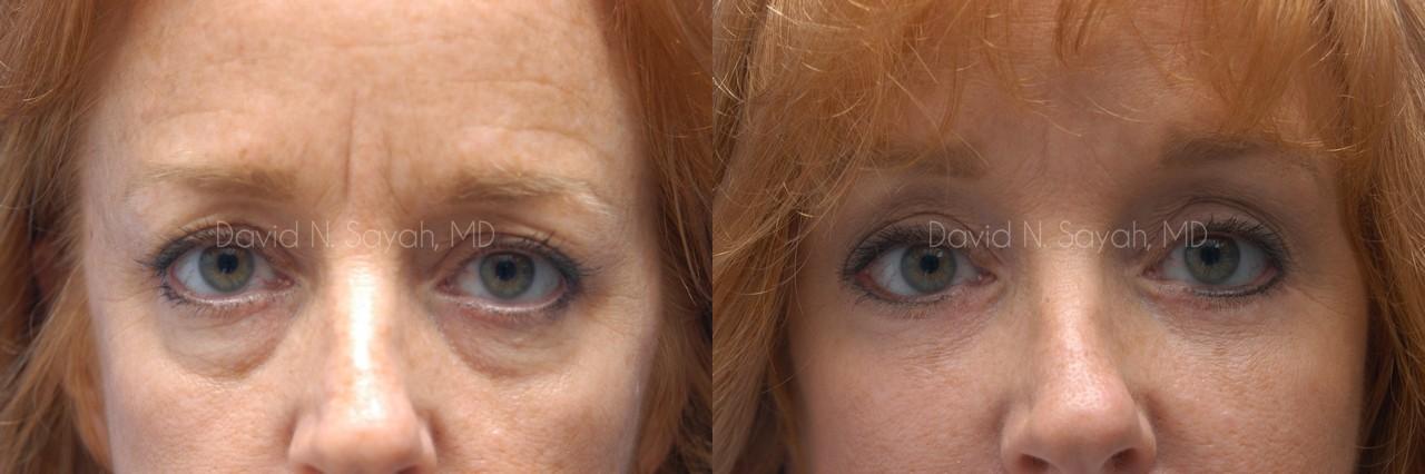 Eyelid Surgery Before and After | Sayah Institute