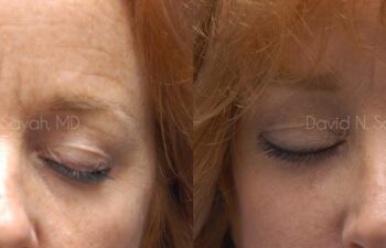 Eyelid Surgery Before and After | Sayah Institute