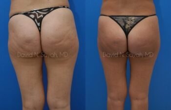 Gluteal Augmentation Before and After | Sayah Institute