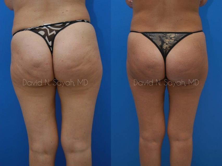 Gluteal Augmentation Before and After | Sayah Institute