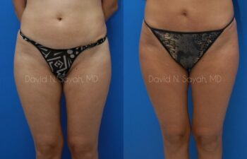 Gluteal Augmentation Before and After | Sayah Institute