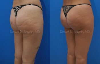 Gluteal Augmentation Before and After | Sayah Institute