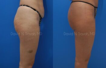 Gluteal Augmentation Before and After | Sayah Institute