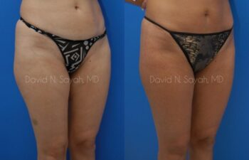 Gluteal Augmentation Before and After | Sayah Institute