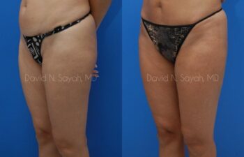 Gluteal Augmentation Before and After | Sayah Institute