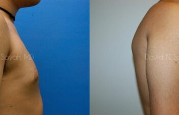 Male Breast Surgery Before and After | Sayah Institute