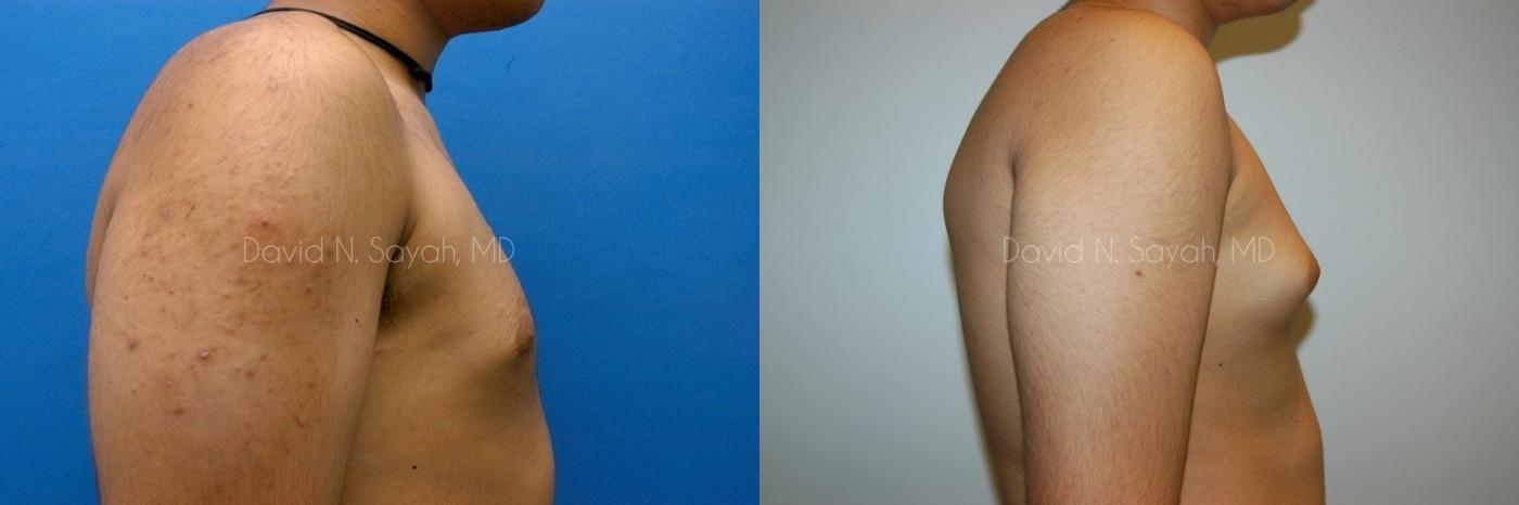 Male Breast Surgery Before and After | Sayah Institute