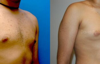 Male Breast Surgery Before and After | Sayah Institute
