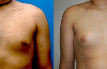 Male Breast Surgery Before and After | Sayah Institute
