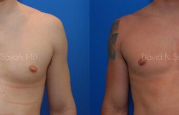 Male Breast Surgery Before and After | Sayah Institute