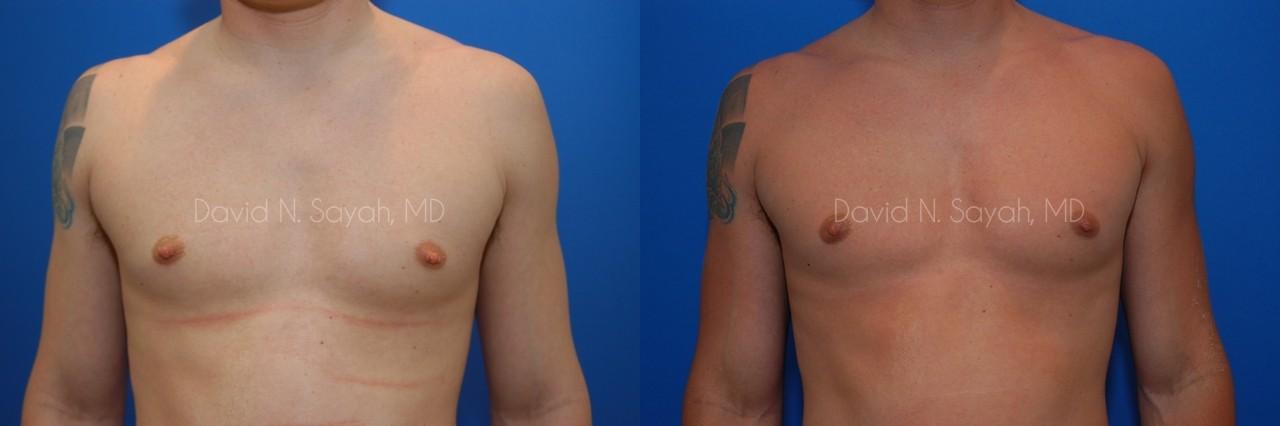 Male Breast Surgery Before and After | Sayah Institute