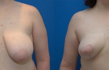 Breast Lift Before and After | Sayah Institute