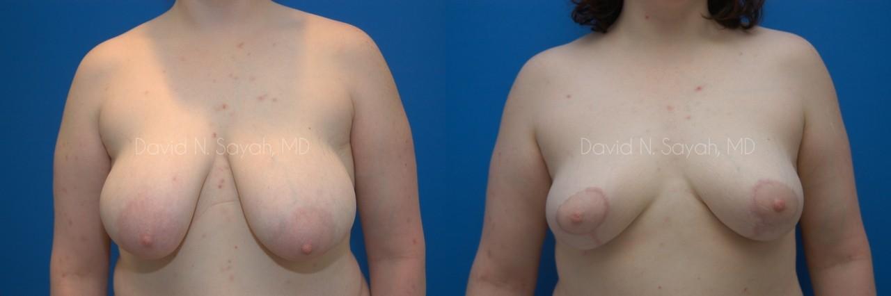 Breast Lift Before and After | Sayah Institute