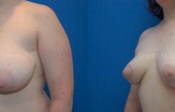 Breast Lift Before and After | Sayah Institute