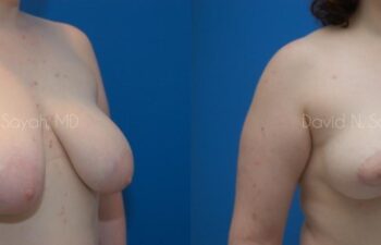 Breast Lift Before and After | Sayah Institute