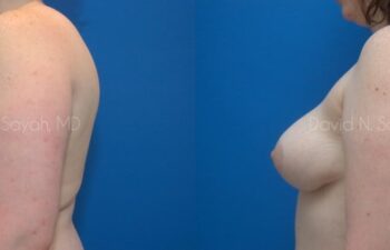 Breast Lift Before and After | Sayah Institute