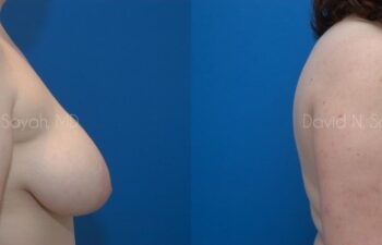 Breast Lift Before and After | Sayah Institute