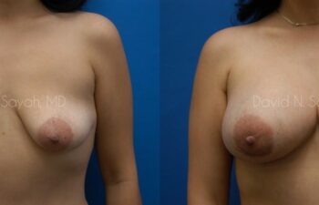 Breast Augmentation And Mastopexy Before and After | Sayah Institute