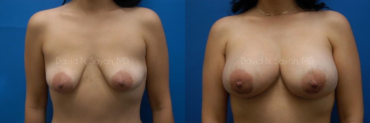 Breast Augmentation And Mastopexy Before and After | Sayah Institute