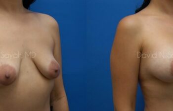 Breast Augmentation And Mastopexy Before and After | Sayah Institute