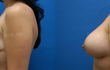 Breast Augmentation And Mastopexy Before and After | Sayah Institute