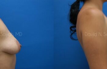 Breast Augmentation And Mastopexy Before and After | Sayah Institute