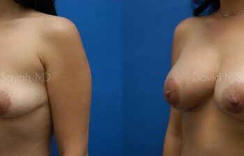 Breast Augmentation And Mastopexy Before and After | Sayah Institute