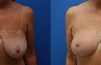 Breast Lift Before and After | Sayah Institute