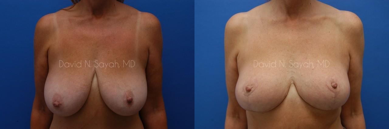 Breast Lift Before and After | Sayah Institute