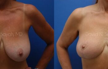 Breast Lift Before and After | Sayah Institute