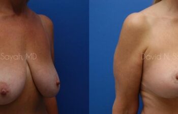 Breast Lift Before and After | Sayah Institute