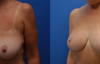 Breast Lift Before and After | Sayah Institute