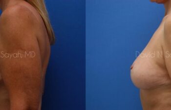 Breast Lift Before and After | Sayah Institute