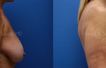 Breast Lift Before and After | Sayah Institute