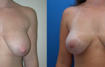 Breast Lift Before and After | Sayah Institute