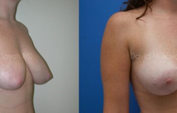 Breast Lift Before and After | Sayah Institute